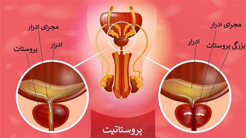 پروستات